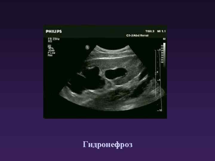 Гидронефроз 