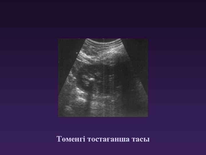 Төменгі тостағанша тасы 