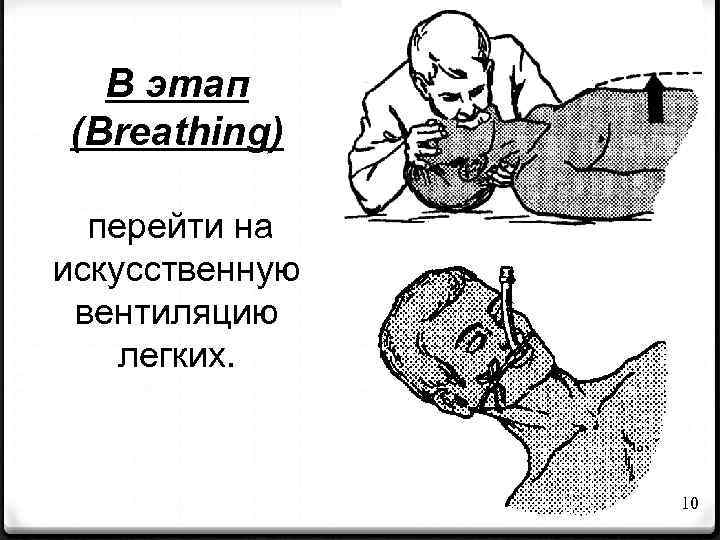 B этап (Breathing) перейти на искусственную вентиляцию легких. 10 