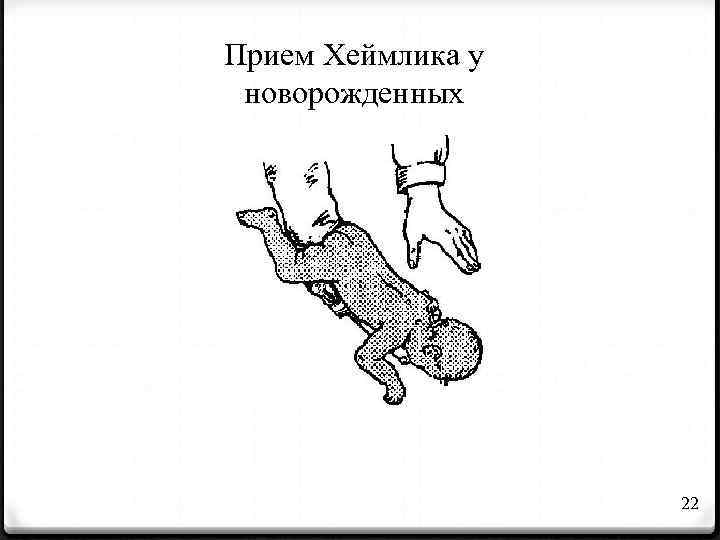 Прием Хеймлика у новорожденных 22 