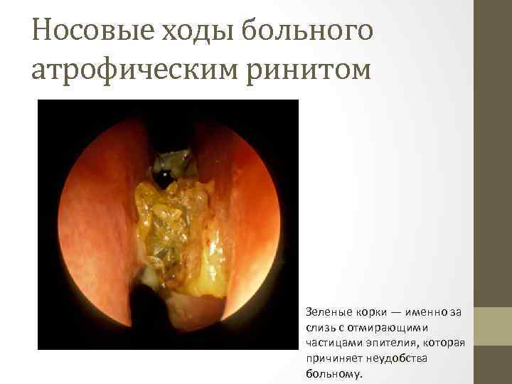 Носовые ходы больного атрофическим ринитом Зеленые корки — именно за слизь с отмирающими частицами