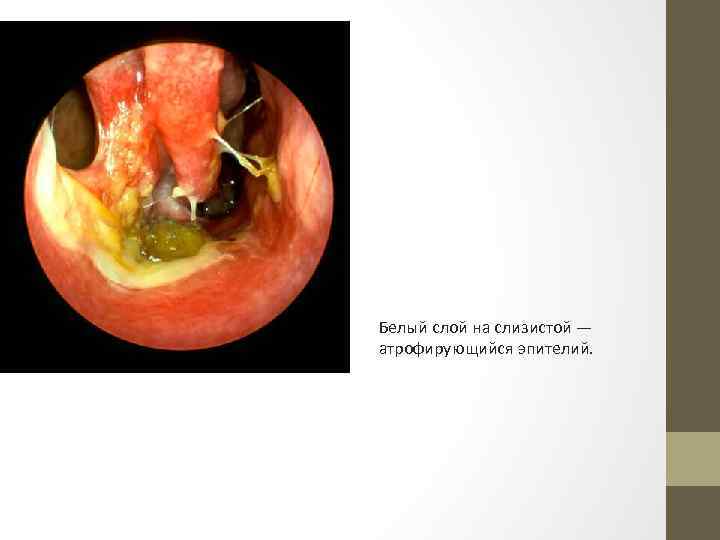 Белый слой на слизистой — атрофирующийся эпителий. 