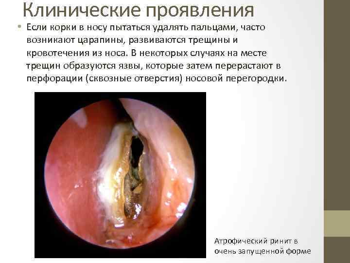 Клинические проявления • Если корки в носу пытаться удалять пальцами, часто возникают царапины, развиваются