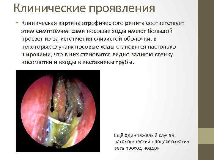 Клинические проявления • Клиническая картина атрофического ринита соответствует этим симптомам: сами носовые ходы имеют
