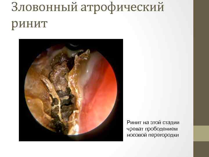 Зловонный атрофический ринит Ринит на этой стадии чреват прободением носовой перегородки 