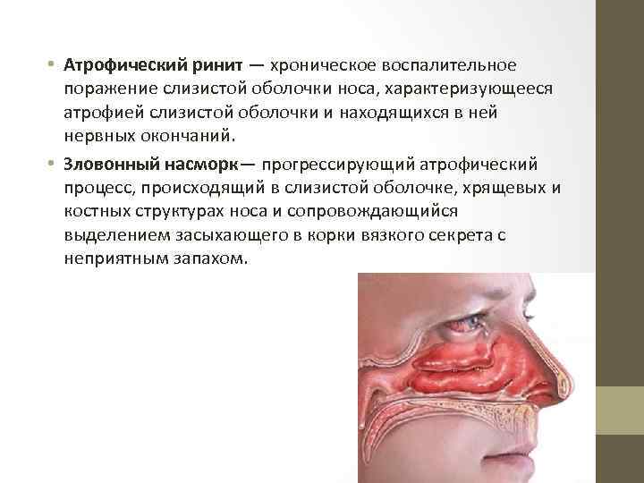  • Атрофический ринит — хроническое воспалительное поражение слизистой оболочки носа, характеризующееся атрофией слизистой
