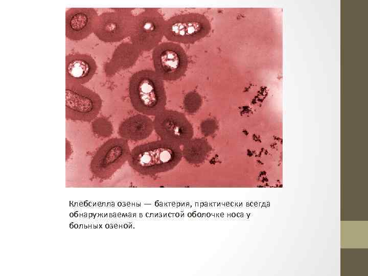 Клебсиелла озены — бактерия, практически всегда обнаруживаемая в слизистой оболочке носа у больных озеной.