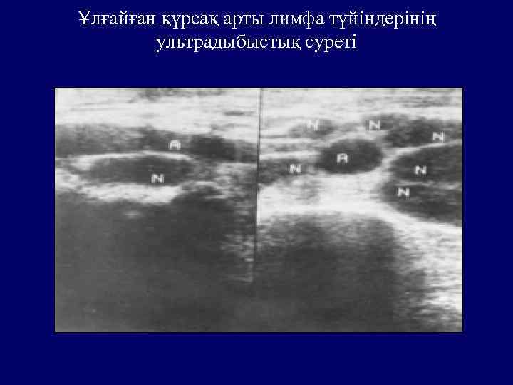 Ұлғайған құрсақ арты лимфа түйіндерінің ультрадыбыстық суреті 