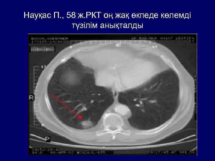 Науқас П. , 58 ж. РКТ оң жақ өкпеде көлемді түзілім анықталды 