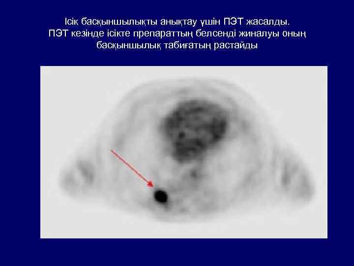 Ісік басқыншылықты анықтау үшін ПЭТ жасалды. ПЭТ кезінде ісікте препараттың белсенді жиналуы оның басқыншылық