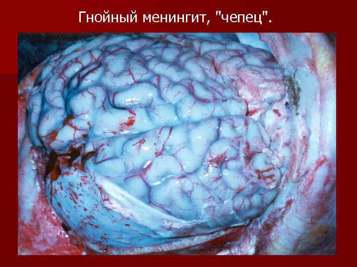 Гнойный менингит, "чепец". 