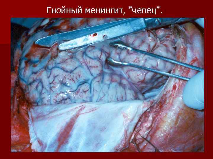 Гнойный менингит, "чепец". 