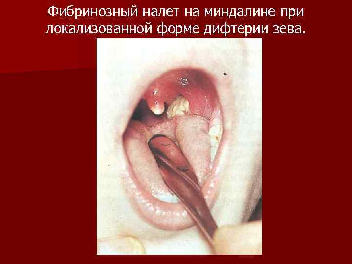 Фибринозный налет на миндалине при локализованной форме дифтерии зева. 