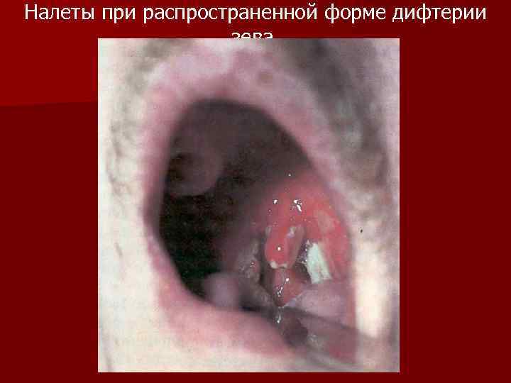 Налеты при распространенной форме дифтерии зева. 