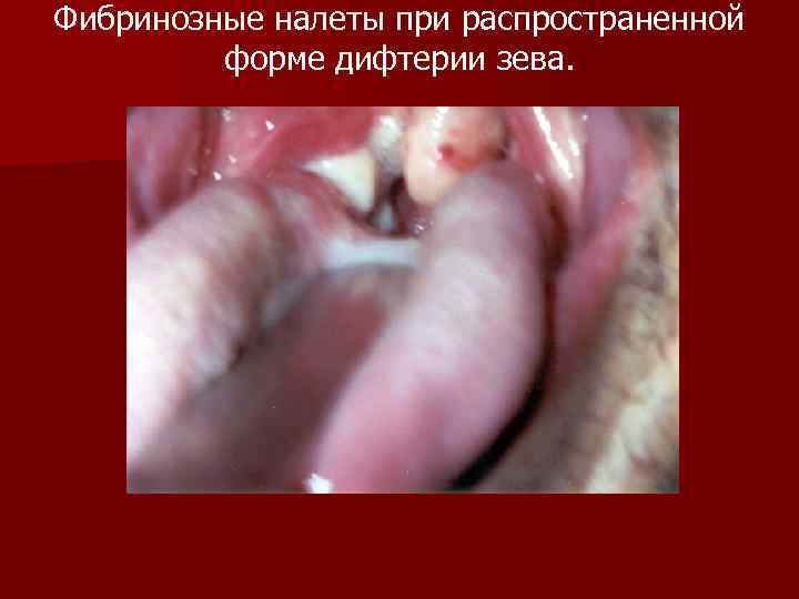 Фибринозные налеты при распространенной форме дифтерии зева. 