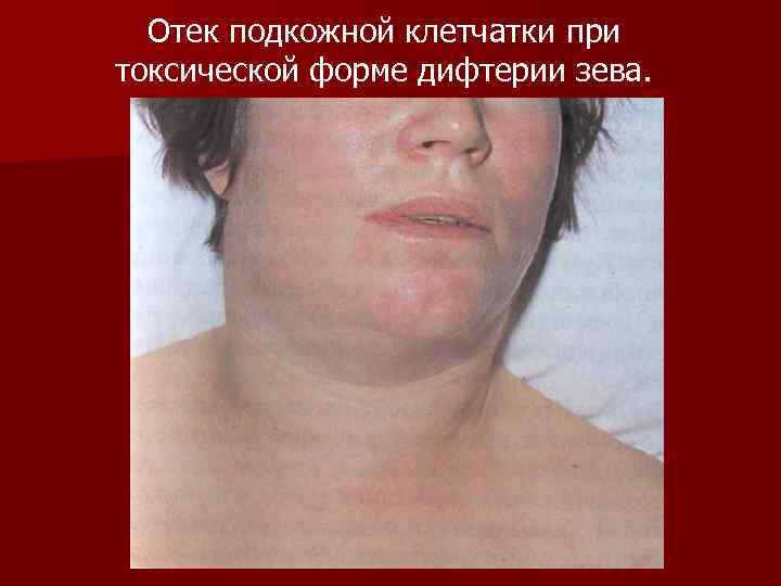 Отек подкожной клетчатки при токсической форме дифтерии зева. 