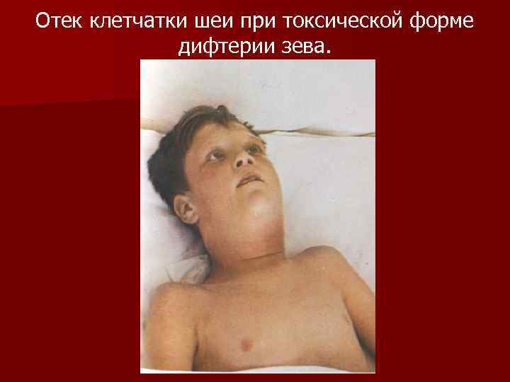 Отек клетчатки шеи при токсической форме дифтерии зева. 