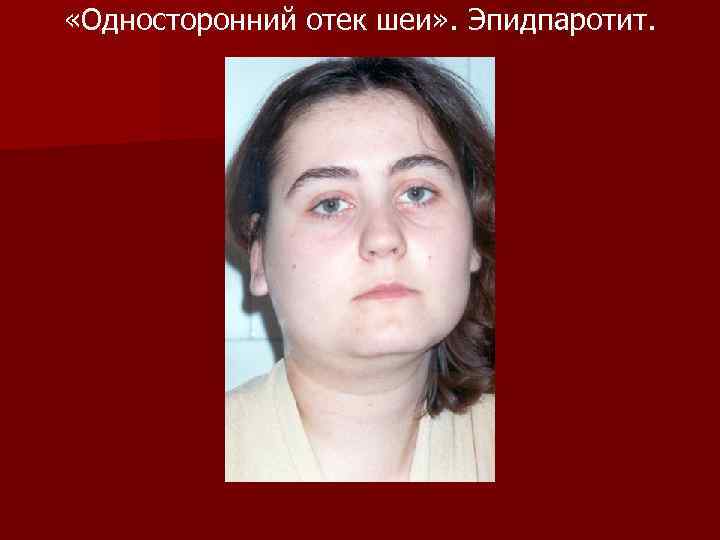  «Односторонний отек шеи» . Эпидпаротит. 