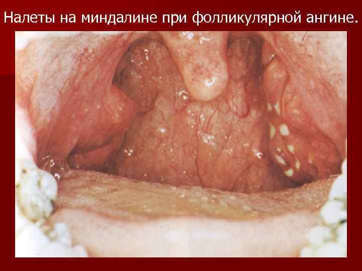 Налеты на миндалине при фолликулярной ангине. 