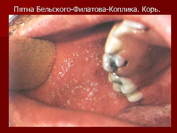 Пятна Бельского-Филатова-Коплика. Корь. 