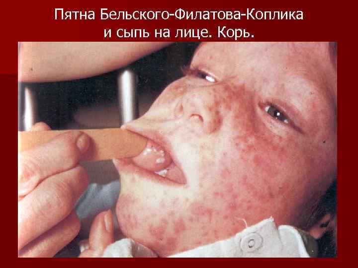 Пятна Бельского-Филатова-Коплика и сыпь на лице. Корь. 