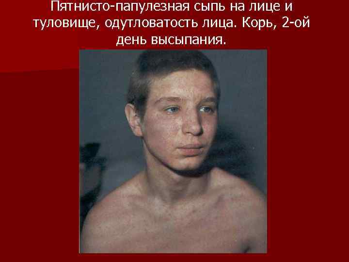 Пятнисто-папулезная сыпь на лице и туловище, одутловатость лица. Корь, 2 -ой день высыпания. 