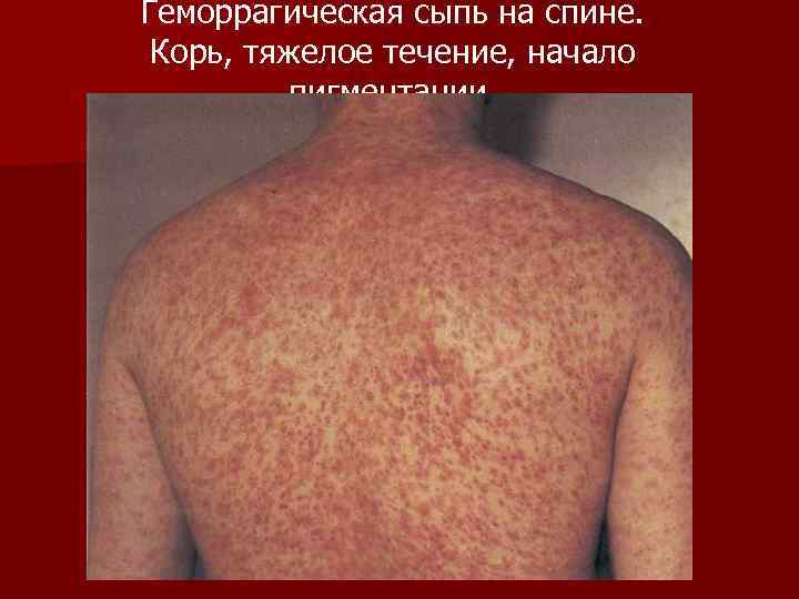 Геморрагическая сыпь на спине. Корь, тяжелое течение, начало пигментации. 