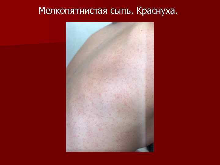 Мелкопятнистая сыпь. Краснуха. 