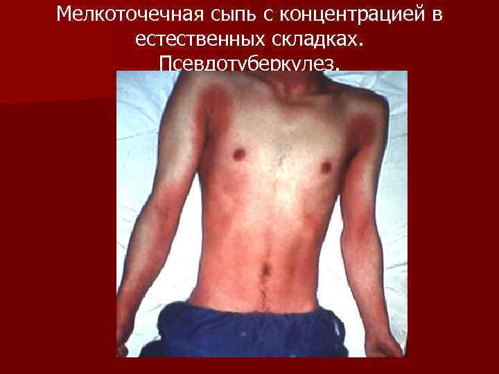 Мелкоточечная сыпь с концентрацией в естественных складках. Псевдотуберкулез. 