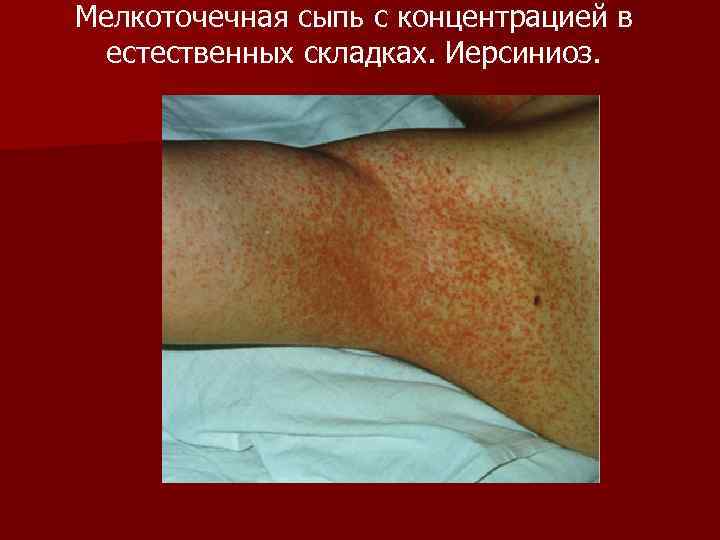 Мелкоточечная сыпь с концентрацией в естественных складках. Иерсиниоз. 