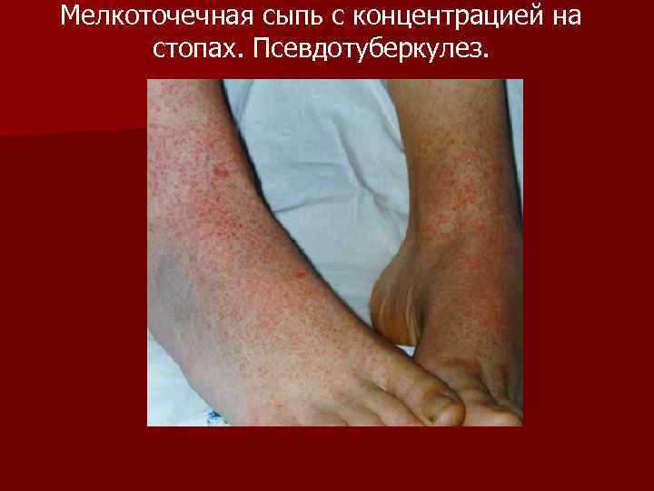 Мелкоточечная сыпь с концентрацией на стопах. Псевдотуберкулез. 