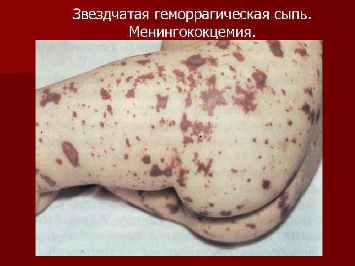 Звездчатая геморрагическая сыпь. Менингококцемия. 