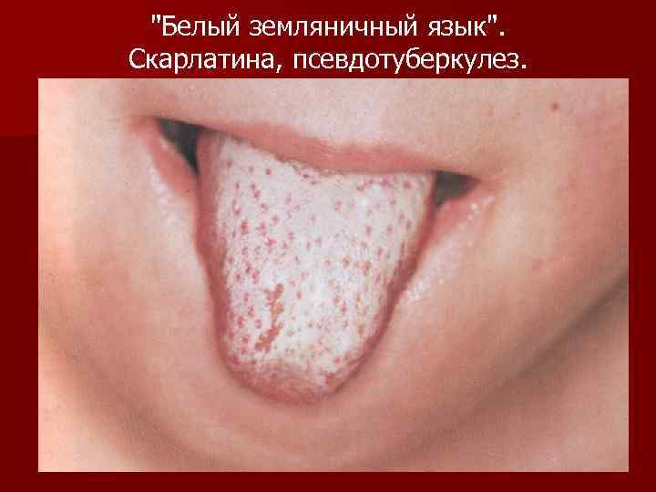 "Белый земляничный язык". Скарлатина, псевдотуберкулез. 
