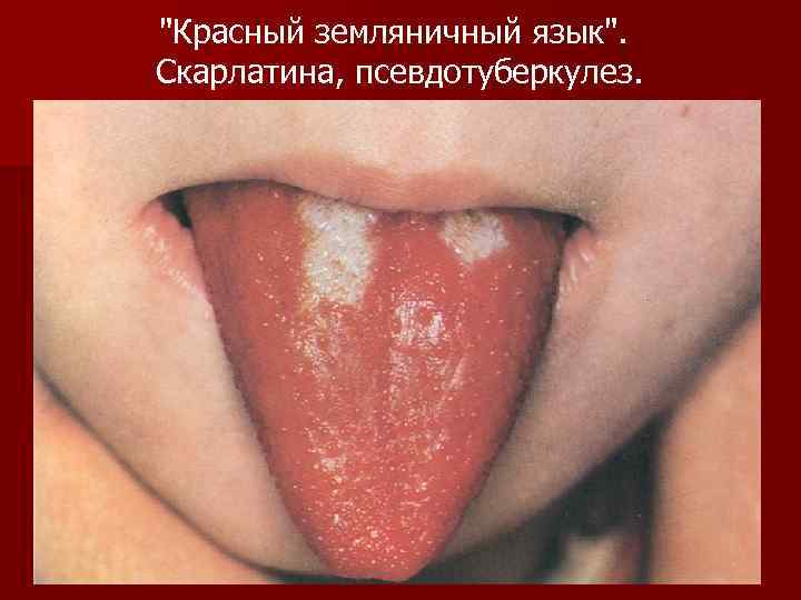 "Красный земляничный язык". Скарлатина, псевдотуберкулез. 