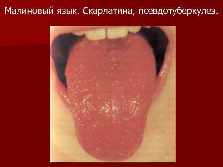 Малиновый язык. Скарлатина, псевдотуберкулез. 
