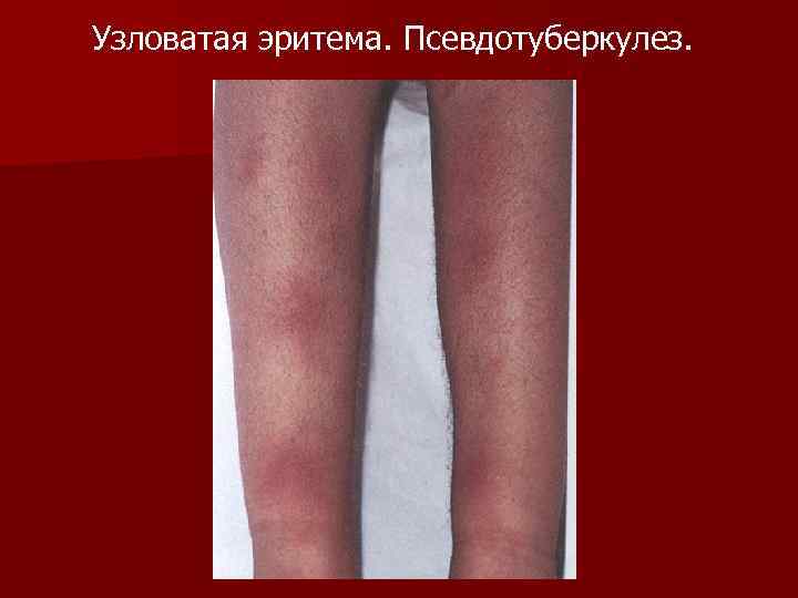 Узловатая эритема. Псевдотуберкулез. 