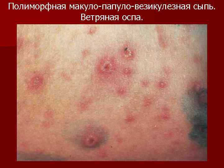 Полиморфная макуло-папуло-везикулезная сыпь. Ветряная оспа. 