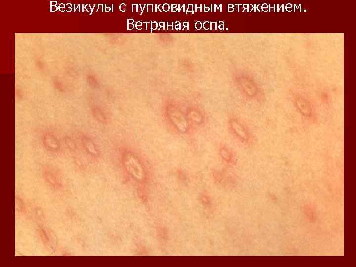 Везикулы с пупковидным втяжением. Ветряная оспа. 