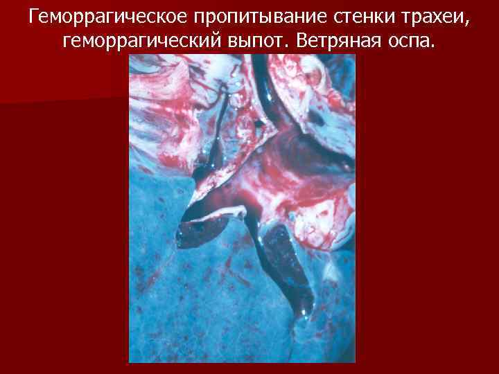 Геморрагическое пропитывание стенки трахеи, геморрагический выпот. Ветряная оспа. 