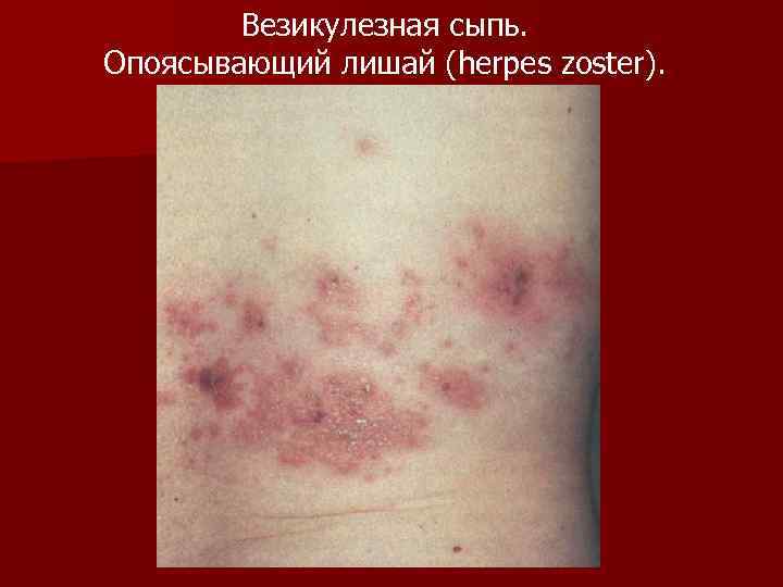 Везикулезная сыпь. Опоясывающий лишай (herpes zoster). 