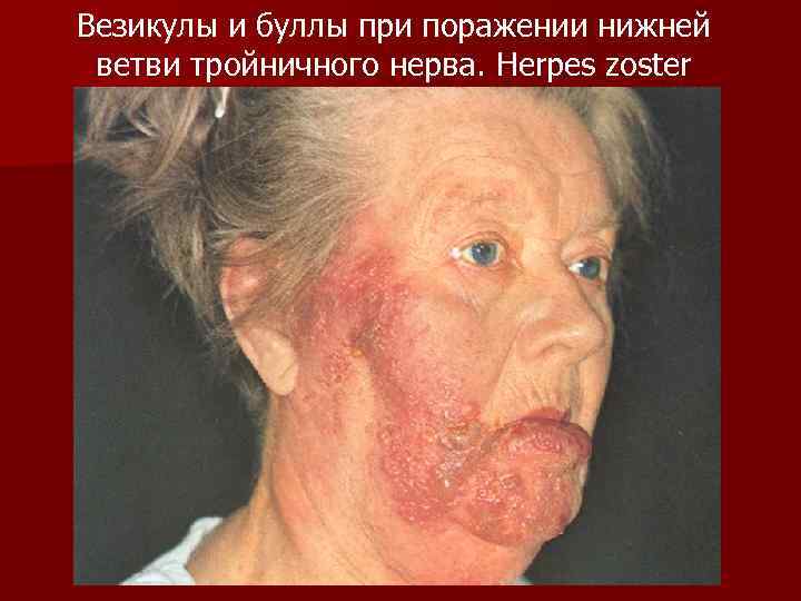 Везикулы и буллы при поражении нижней ветви тройничного нерва. Herpes zoster 