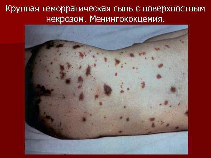 Крупная геморрагическая сыпь с поверхностным некрозом. Менингококцемия. 