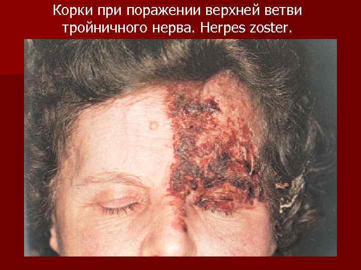 Корки при поражении верхней ветви тройничного нерва. Herpes zoster. 