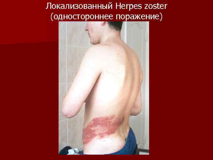 Локализованный Herpes zoster (одностороннее поражение) 