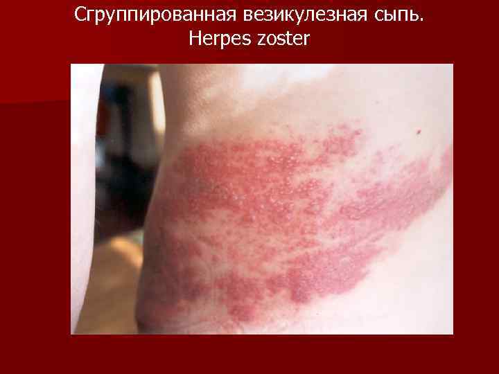 Сгруппированная везикулезная сыпь. Herpes zoster 