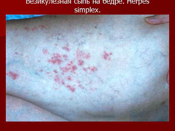 Везикулезная сыпь на бедре. Herpes simplex. 