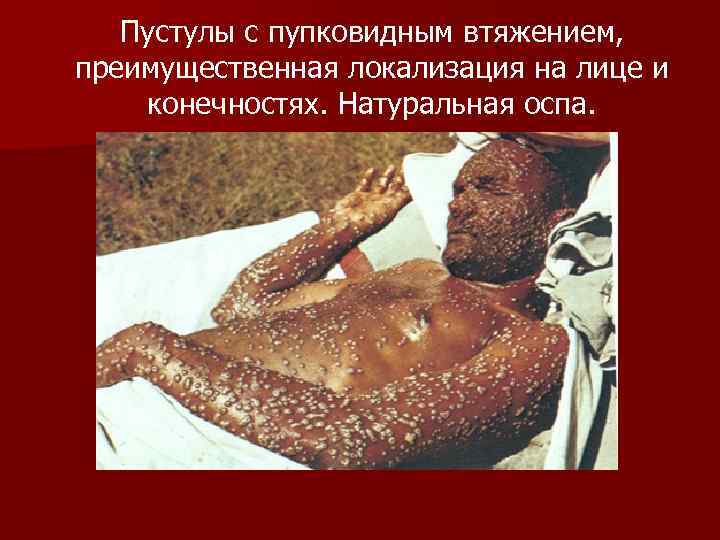 Пустулы с пупковидным втяжением, преимущественная локализация на лице и конечностях. Натуральная оспа. 