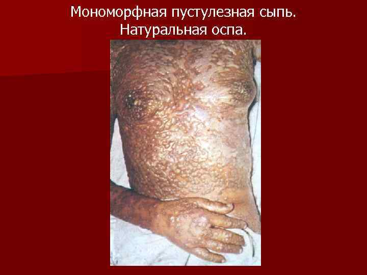 Мономорфная пустулезная сыпь. Натуральная оспа. 