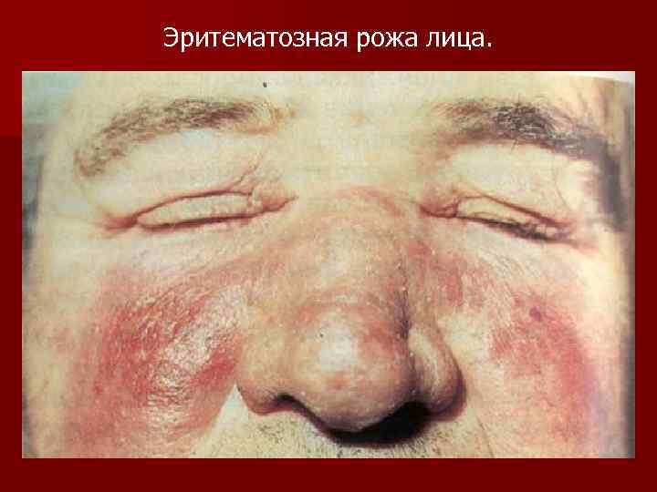 Эритематозная рожа лица. 