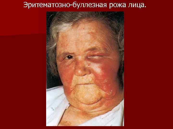 Эритематозно-буллезная рожа лица. 